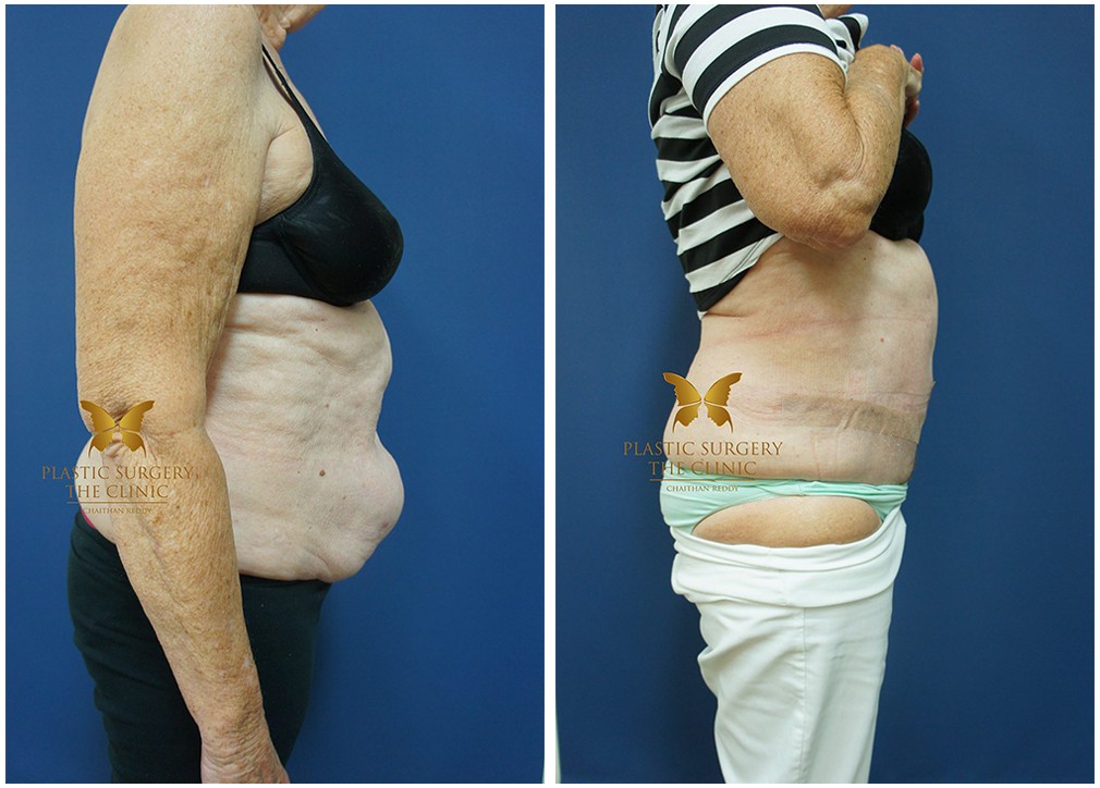 Tummy tuck before and after 14, Dr Reddy Sydney, side view