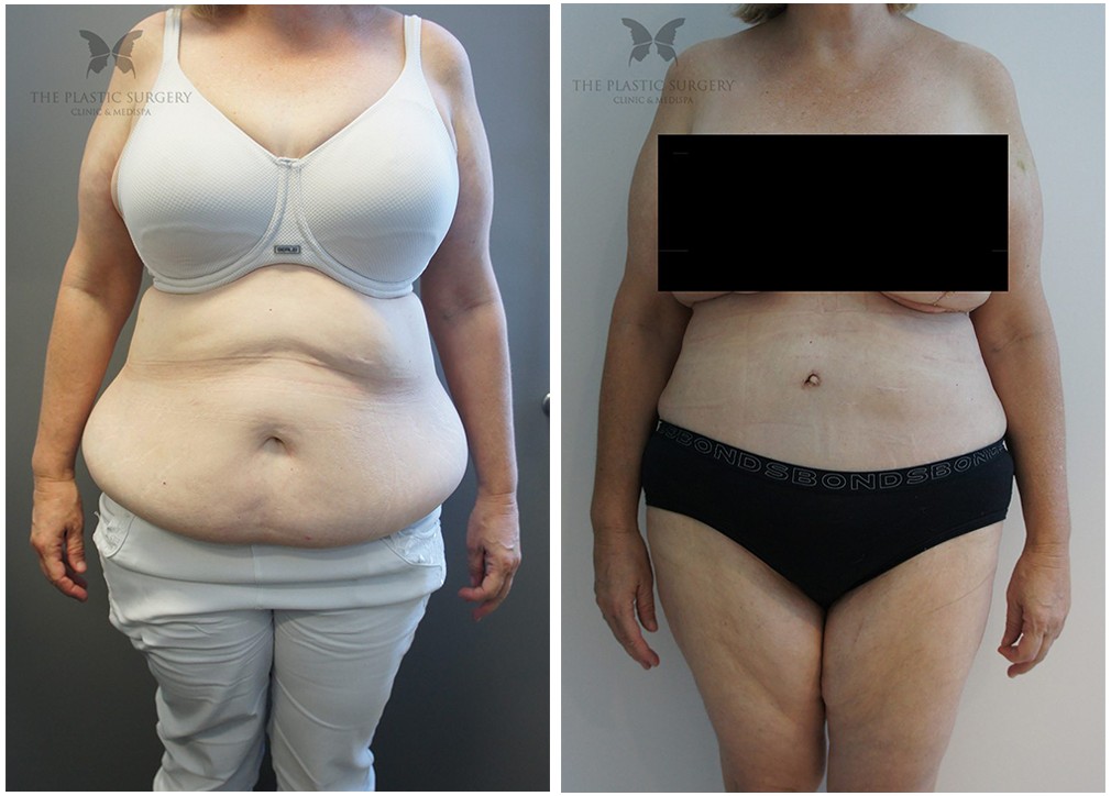 Patient before and after Abdominoplasty surgery 15, TPSC Sydney
