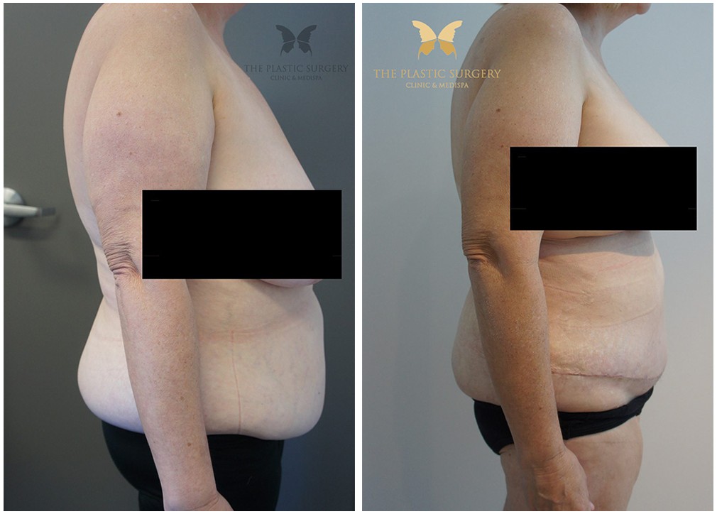 Abdominoplasty Results 17 TPSC