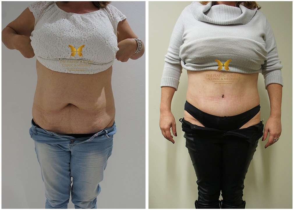 Tummy tuck surgery results 25, female patient , front view