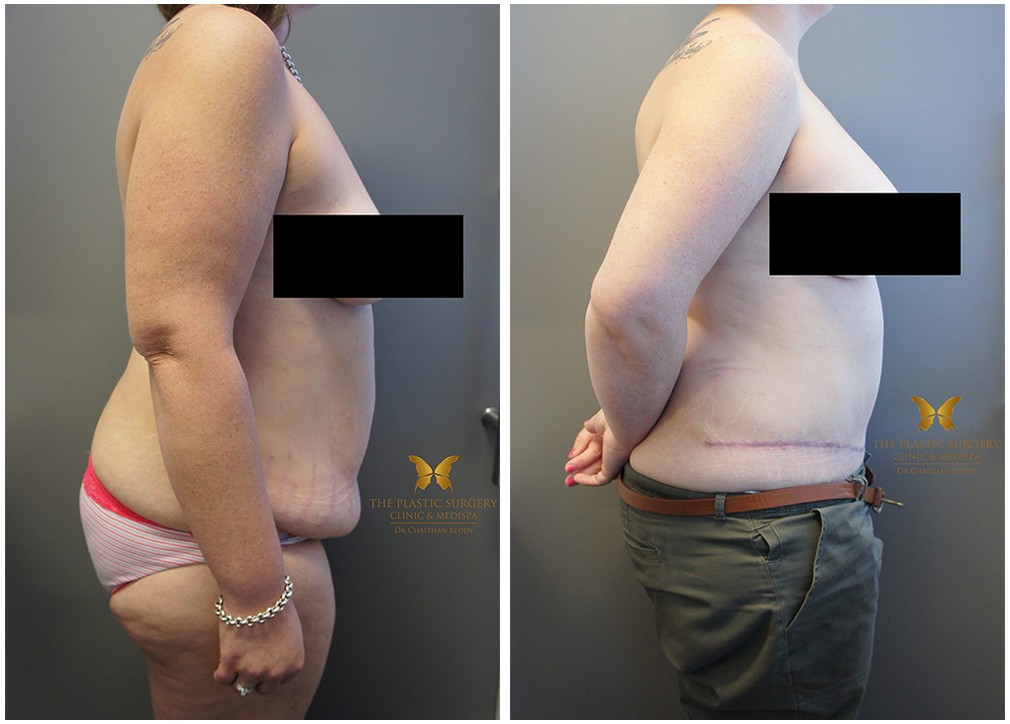 Abdominoplasty Results 31 Side TPSC