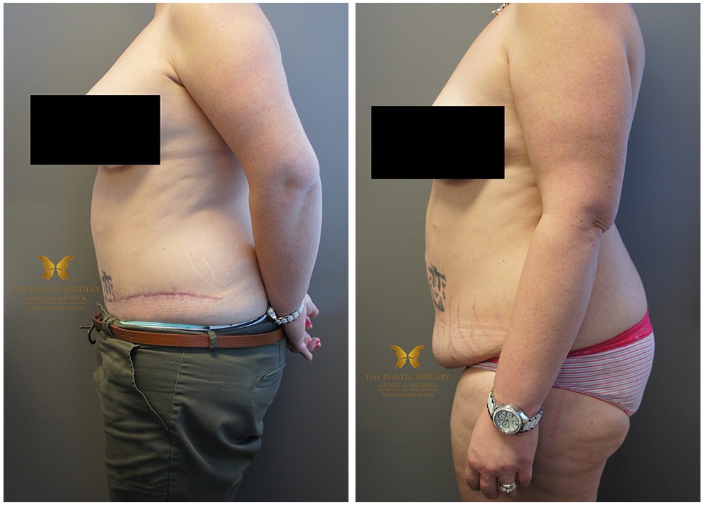 Side view of a tummy tuck patient before and after the surgery 32