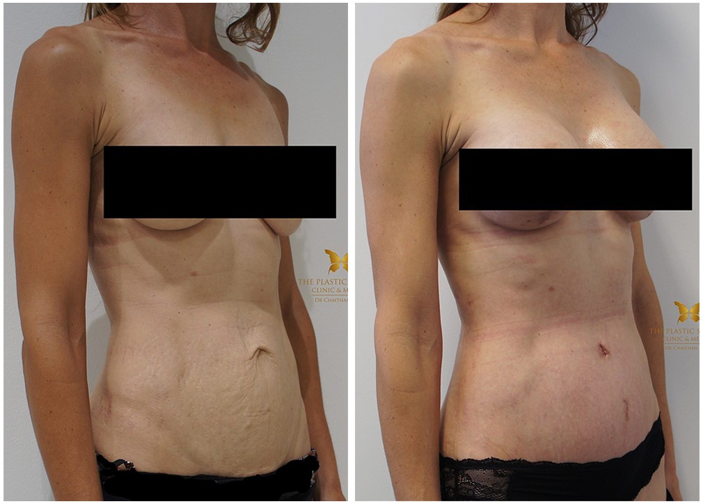 Female patient before and after tummy tuck 34