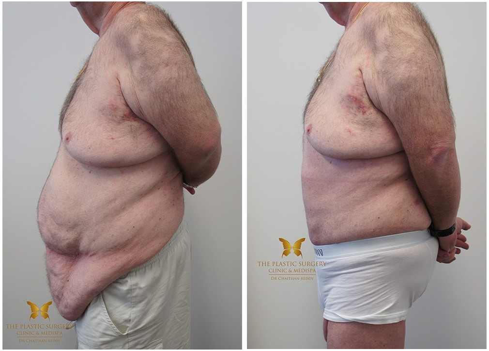 Male tummy tuck patient, before and after 37, Dr Reddy, left side view