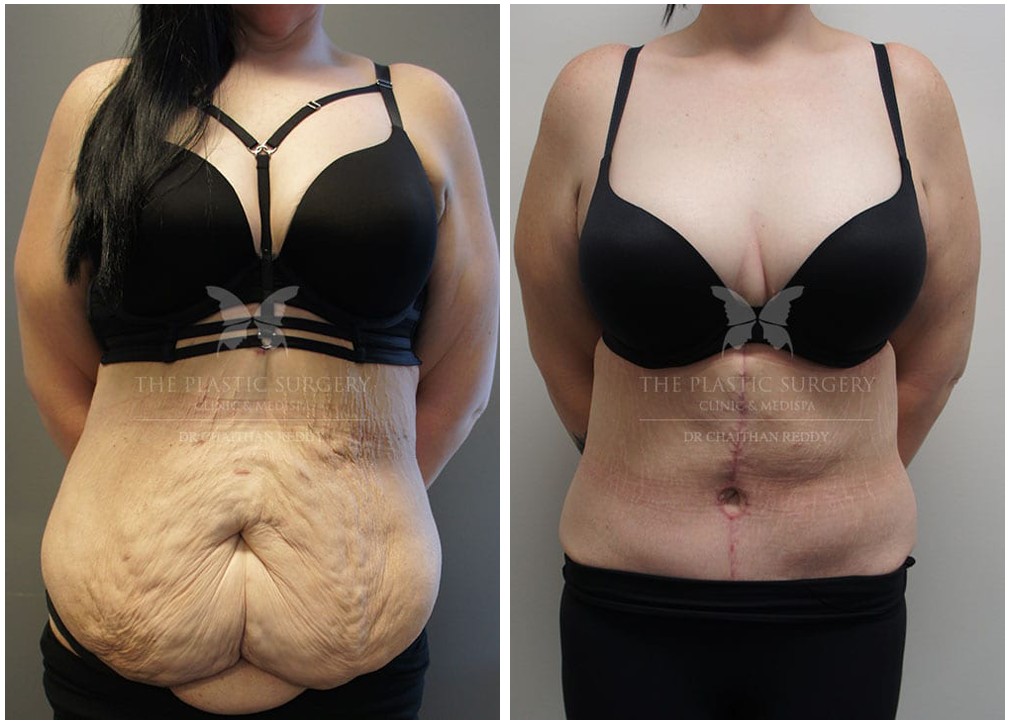 Tummy tuck surgery before and after 39, TPSC