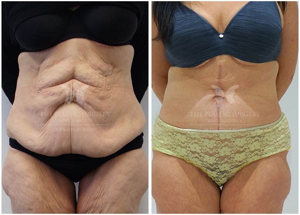 Abdominoplasty surgery, patient before and after 44, front view, Dr Reddy
