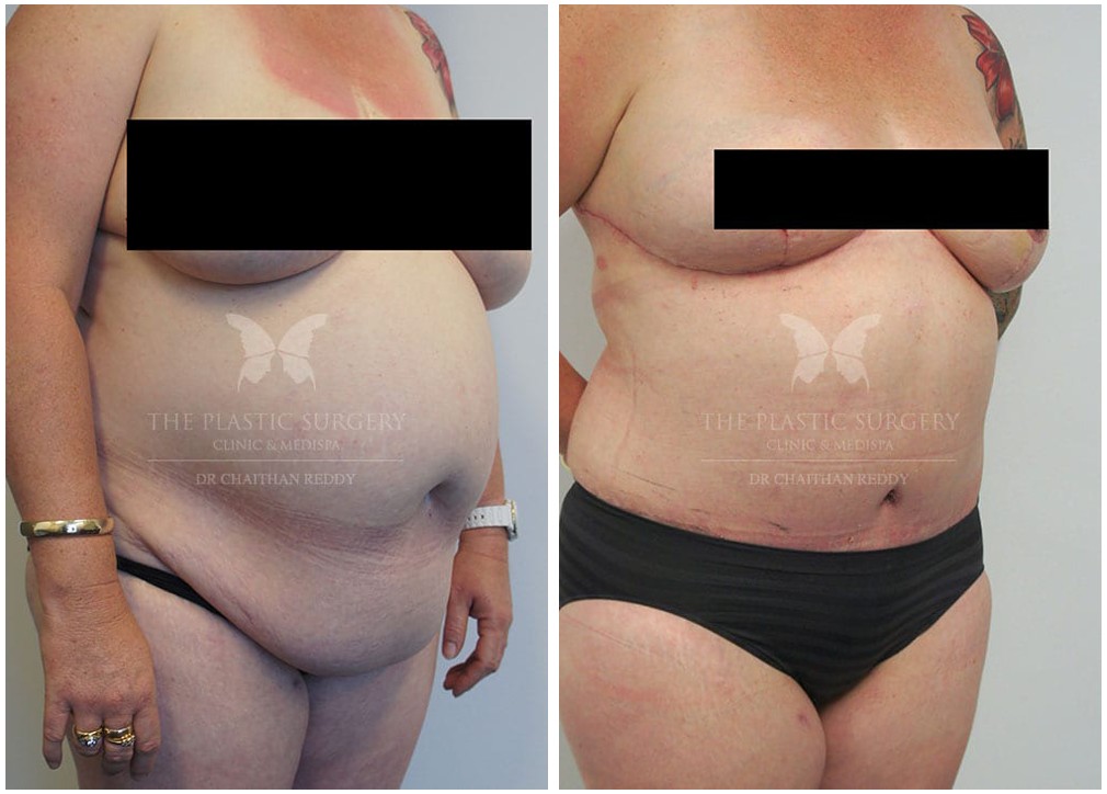 Tummy tuck results 49, female patient, angle view, TPSC Sydney