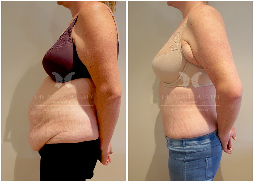 Abdominoplasty before and afters 52, Dr Chaithan Reddy patient, side view