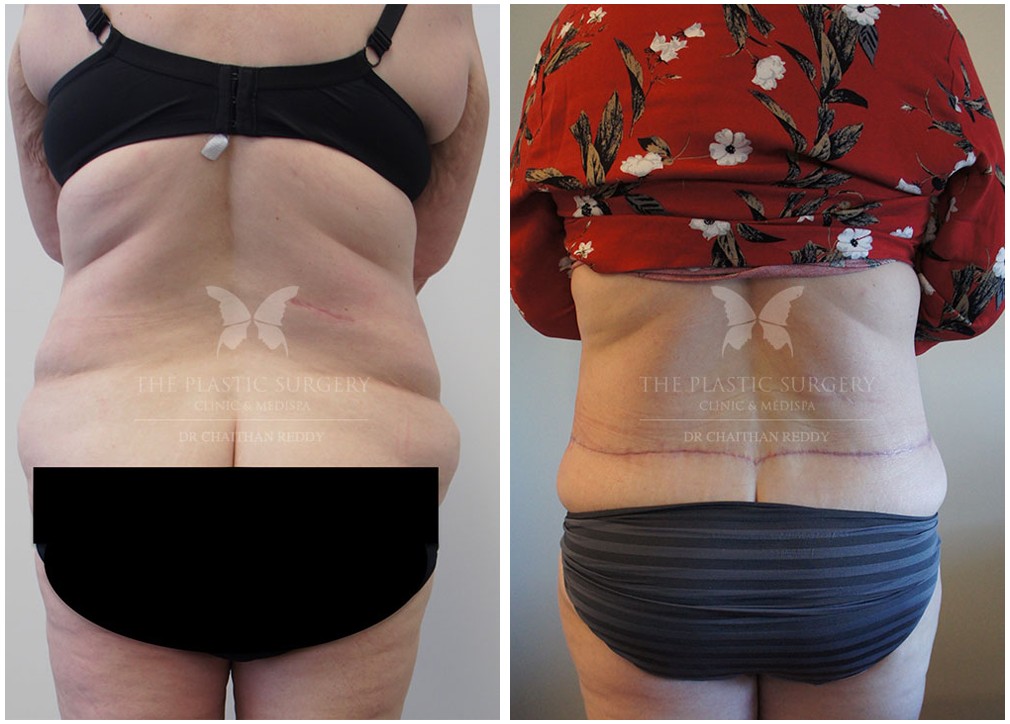 Tummy tuck surgery 53, before and afters, back view