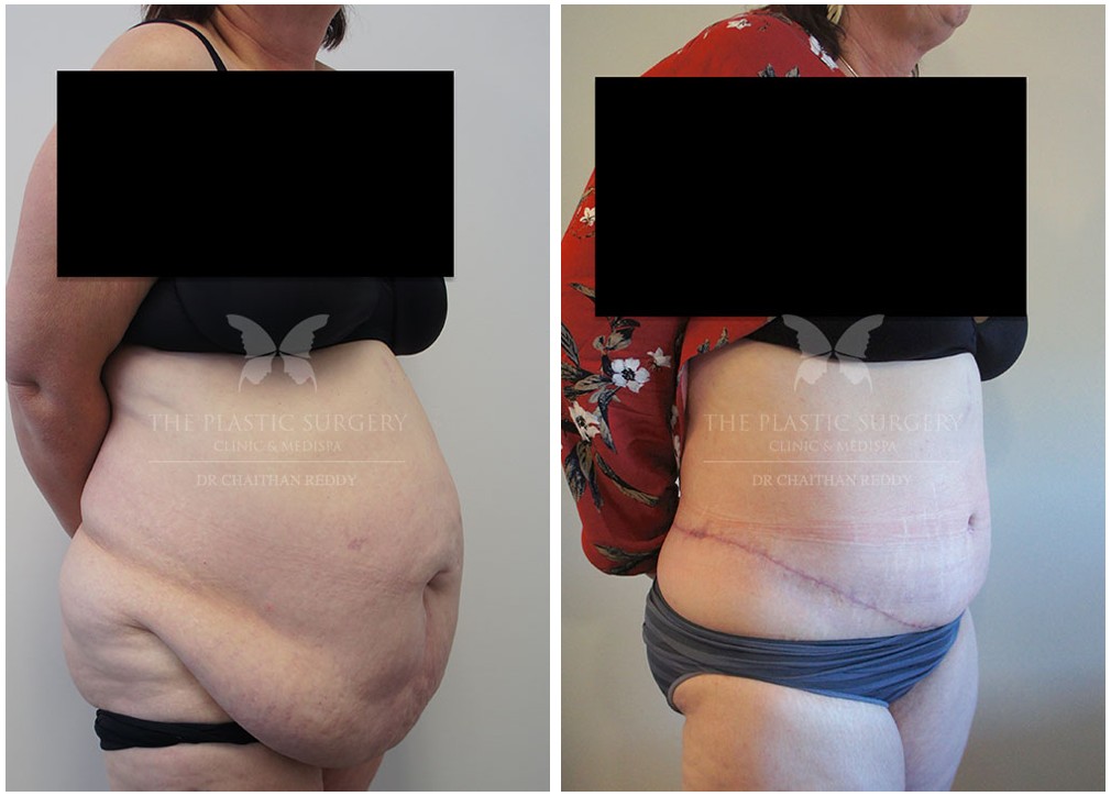 Female patient, abdominoplasty results 54, TPSC Sydney