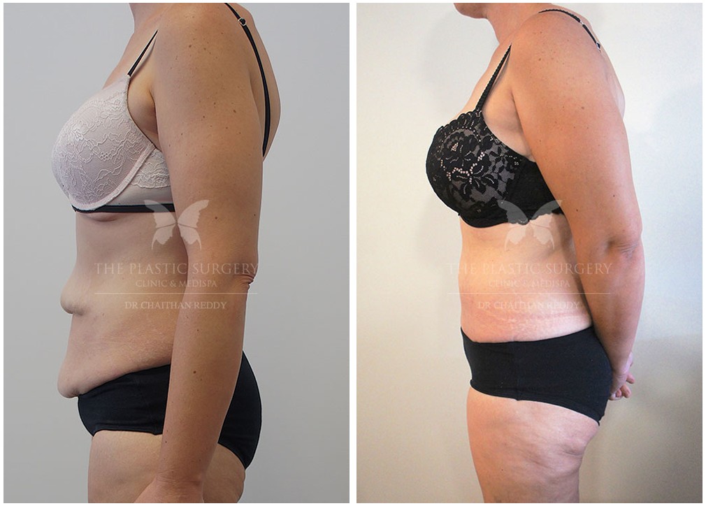 Tummy tuck before and after 57, TPSC, Dr Reddy