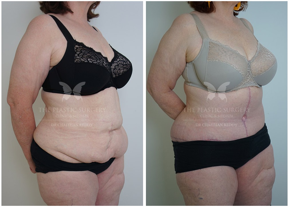 Abdominoplasty before and after 66, angle view