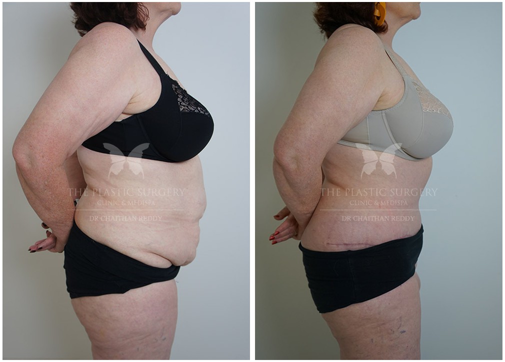 Female patient before and after tummy tuck procedure 67, The Plastic Surgery Clinic