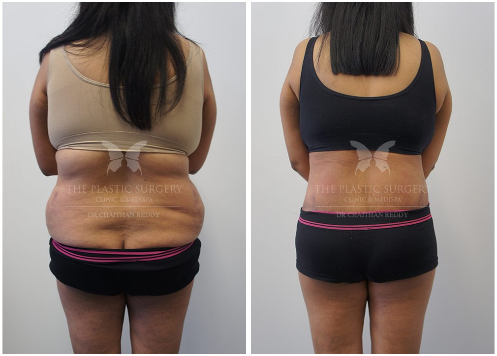 Before and afters 74, tummy tuck, back view, TPSC