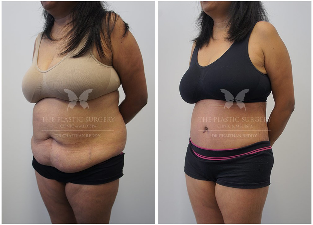 Before and after tummy tuck 75, Dr Reddy Sydney