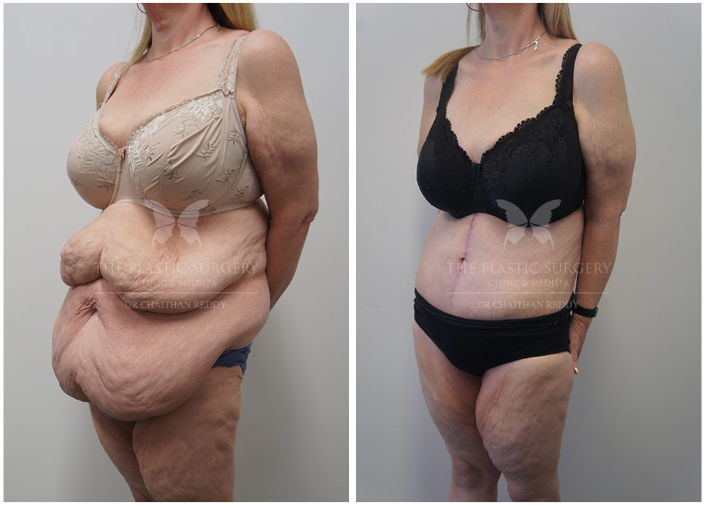 Tummy tuck before and after 80, TPSC Sydney