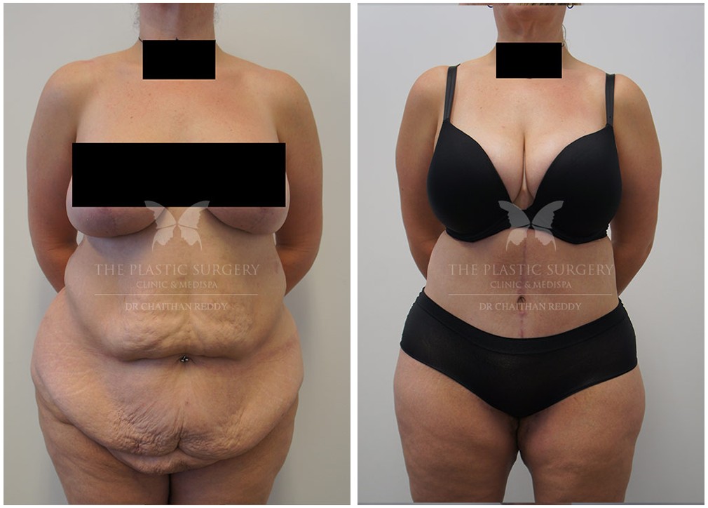Abdominoplasty surgery results 82, TPSC Sydney