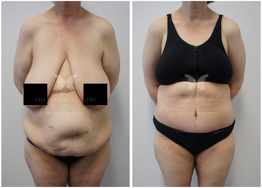 Tummy tuck before and after 84, TPSC, front view