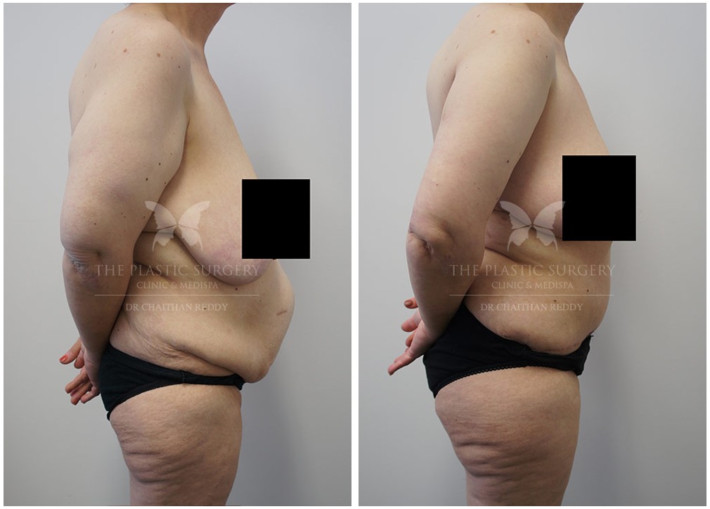 Abdominoplasty surgery, before and after 86, Dr Reddy