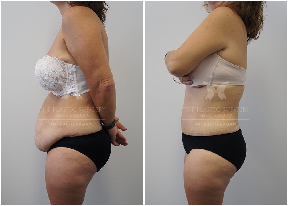 Before and after Abdominoplasty surgery 100, side view