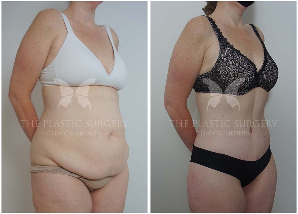 Abdominoplasty before and after 106, TPSC