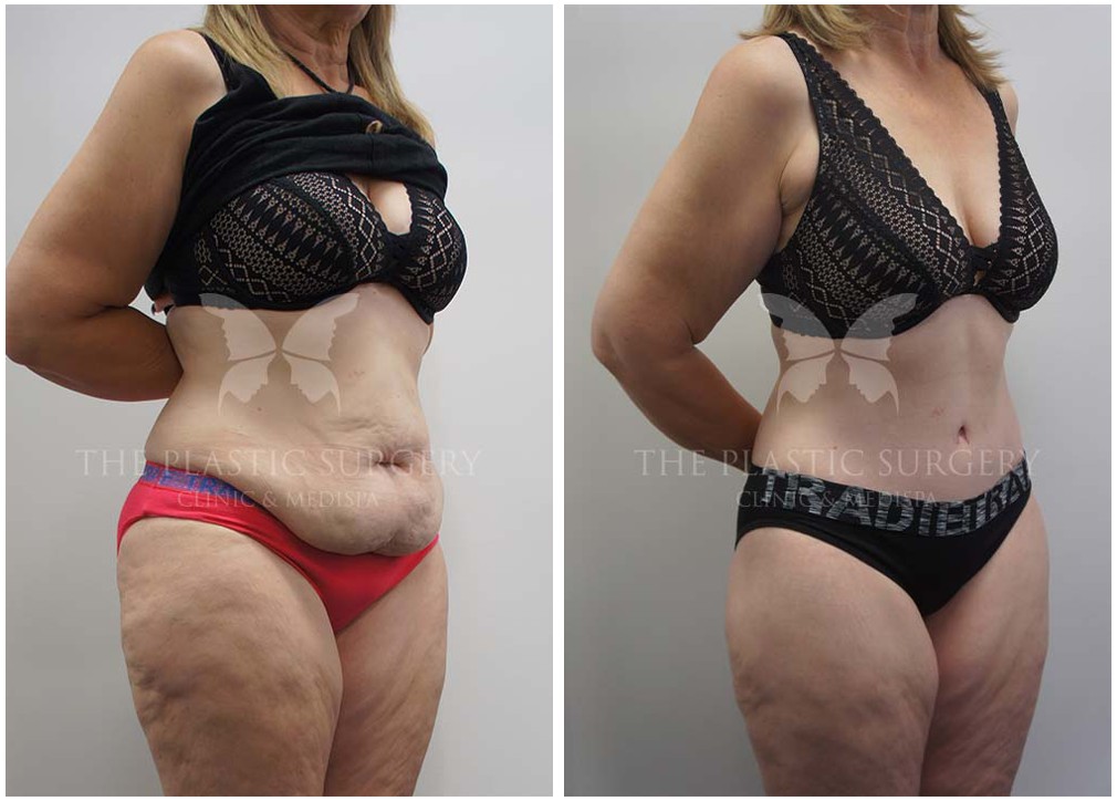 Abdominal plastic surgery, before and after 113, Dr Reddy Sydney
