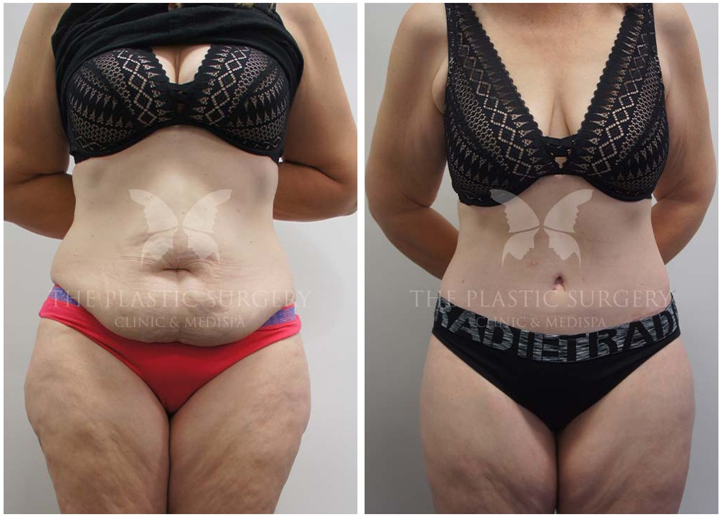Tummy tuck before and after 114, The Plastic Surgery Clinic