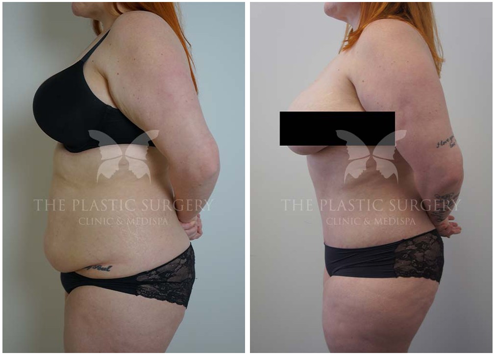 Tummy tuck surgery, before and after 115, TPSC