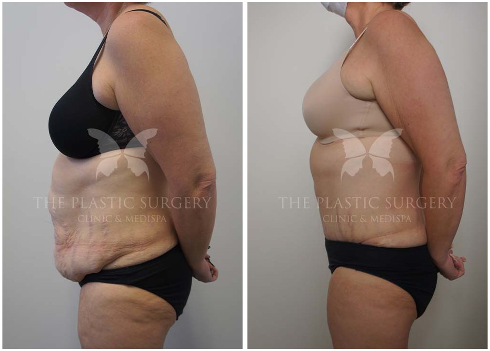 Before and after tummy tuck, TPSC, Dr Reddy