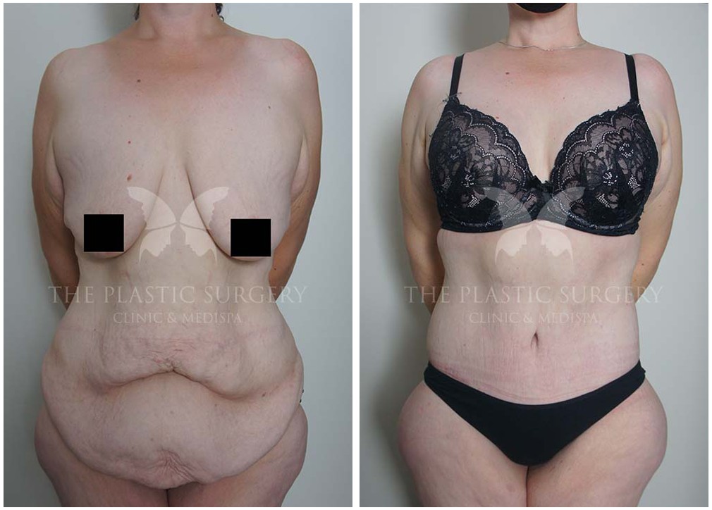 Tummy tuck surgery 125, before and afters, Dr Reddy
