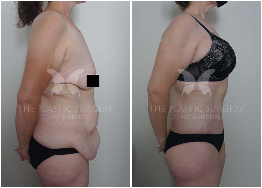 Before and Abdominoplasty 126, Dr Reddy