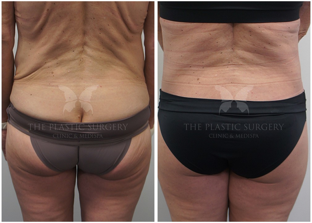 Abdominoplasty surgery, before and after 130, Dr Reddy