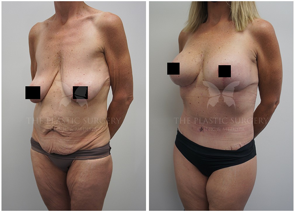 Patient before and after mummy makeover 134 TPSC