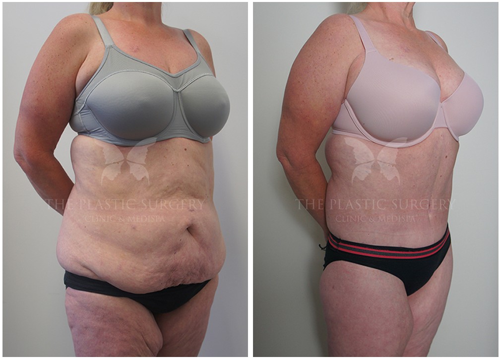 Tummy tuck before and after 136, Dr Reddy Sydney &amp; Central Coast