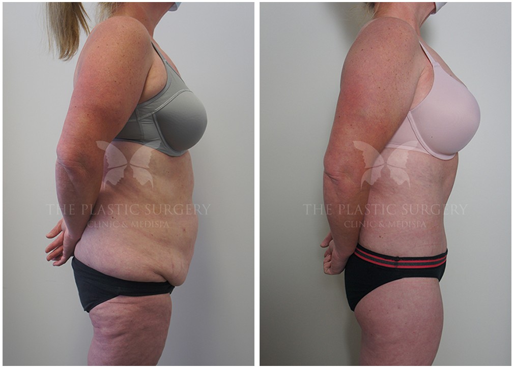 Tummy tuck before and after 137, TPSC Sydney &amp; Central Coast