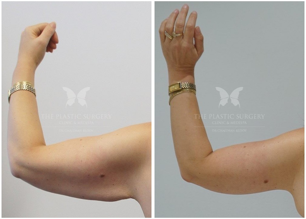 Patient before and after arm lift 02, TPSC