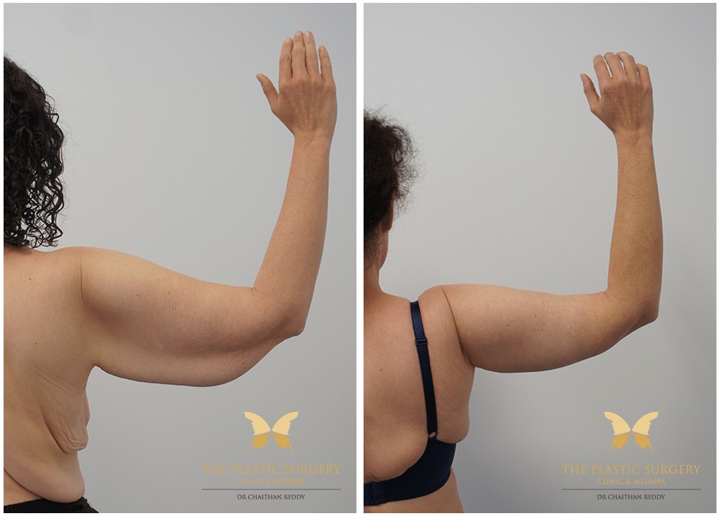Brachioplasty (arm lift), before and after 06, TPSC