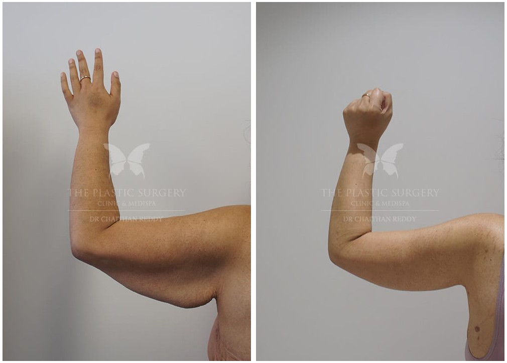 Arm lift patient before and after procedure 08, Dr Reddy Sydney