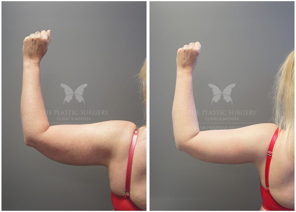 Before and after arm lift 10, The Plastic Surgery Clinic
