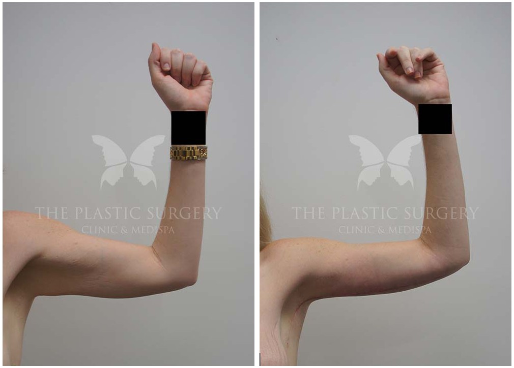 Before and after arm lift 13, The Plastic Surgery Clinic