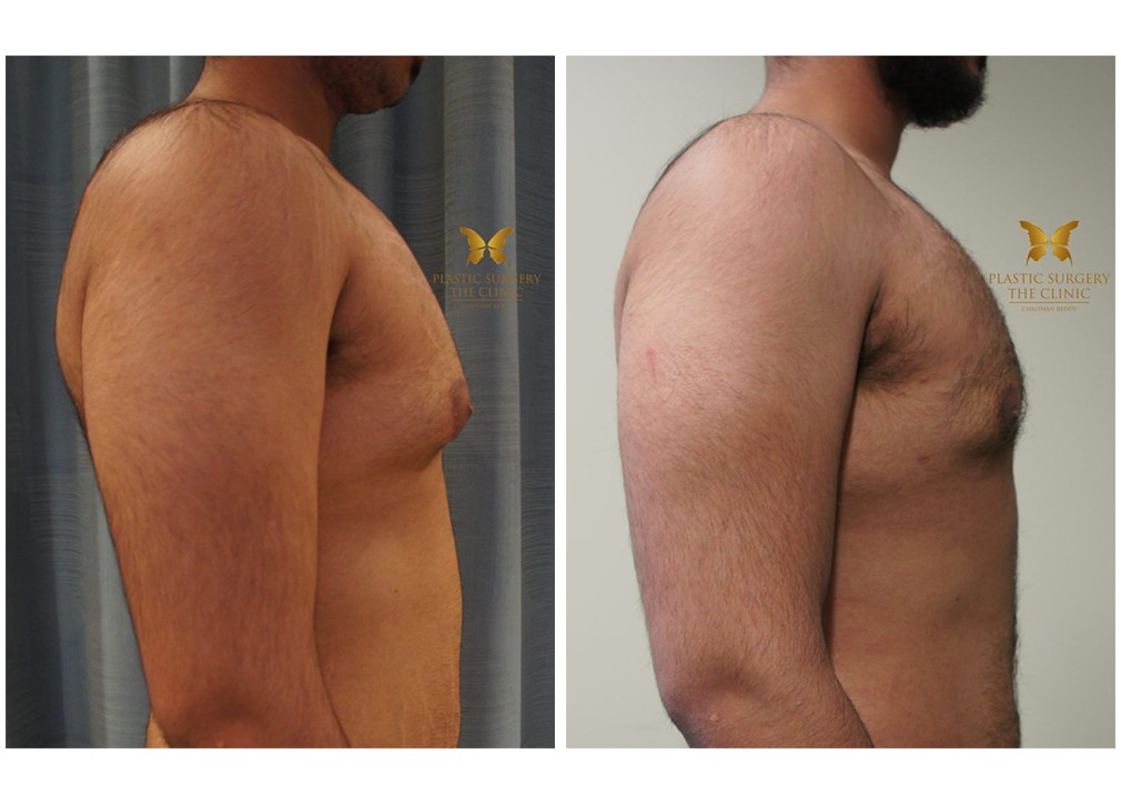 Gynaecomastia surgery before and after 01, TPSC Sydney &amp; Central Coast, side view