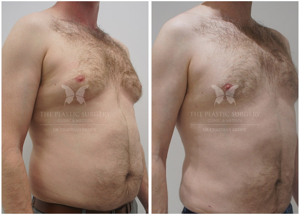 Patient before and after Gynaecomastia surgery, TPSC Sydney