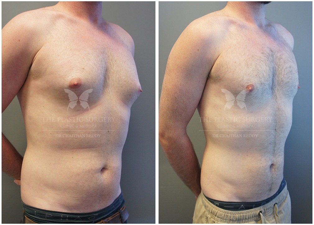 Gyno surgery before and after 12, Dr Reddy