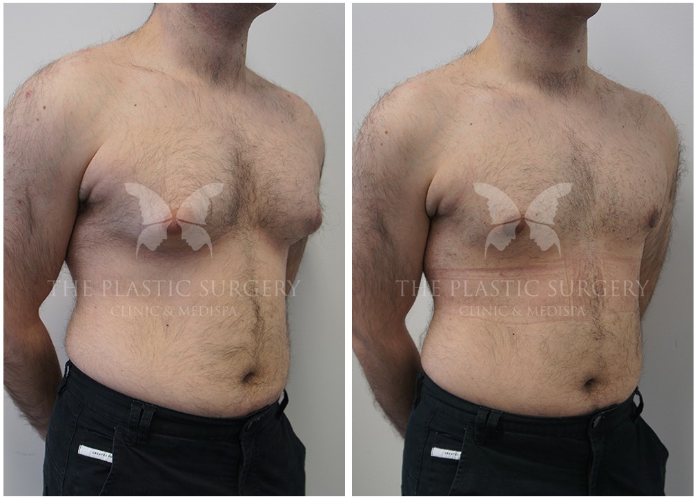 Patient before and after Gynecomastia surgery 15, Dr Reddy plastic surgery