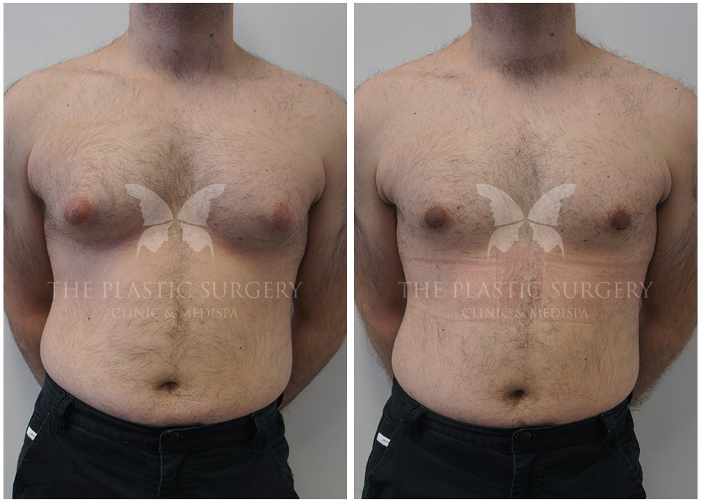 Patient before and after Gyno surgery 16