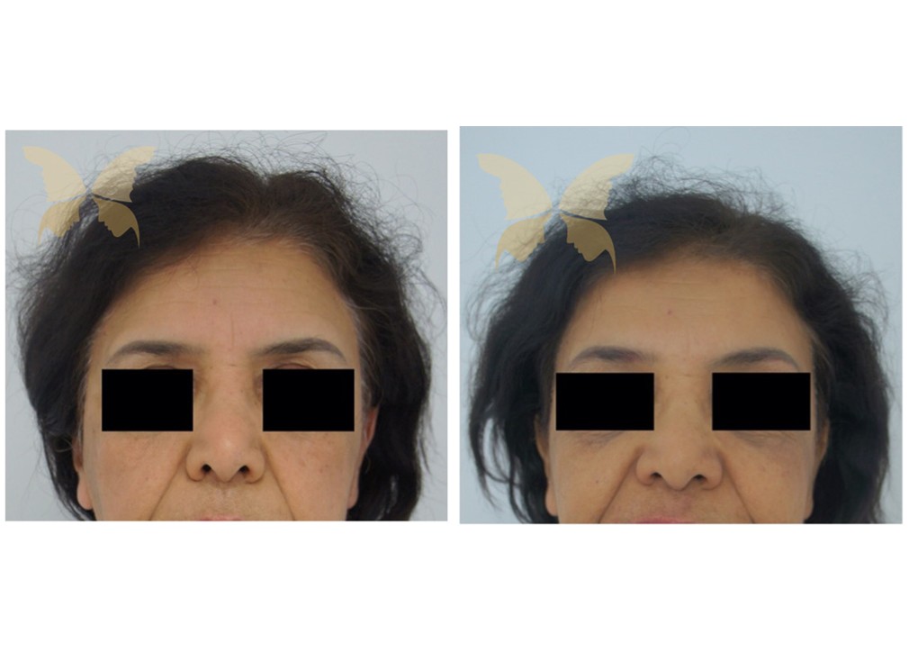Hairline lowering surgery results 02, The Plastic Surgery Clinic Sydney
