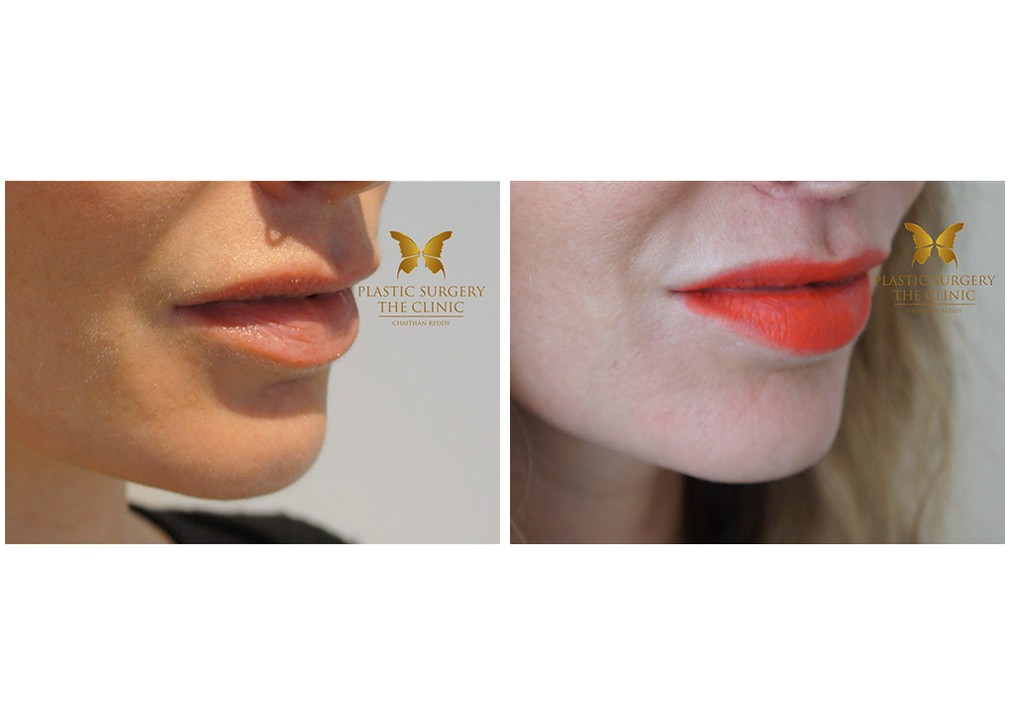 Before and after lip lift 04, Dr Reddy