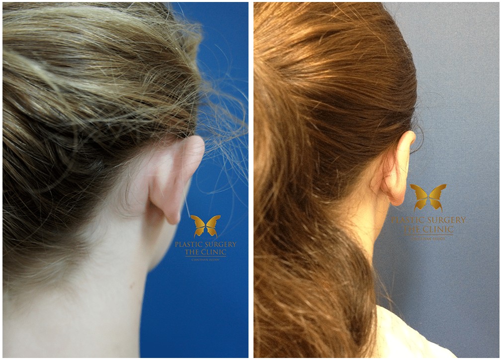 Otoplasty before and after 04, Dr Reddy clinic Sydney &amp; Central Coast
