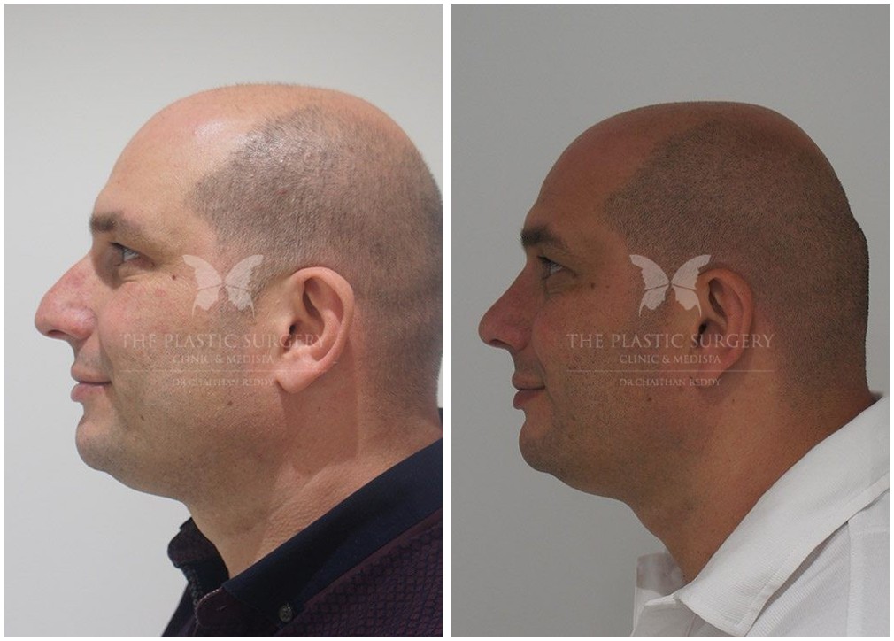 Nose job (Rhinoplasty) patient before and after surgery 01, side view, Dr Reddy Sydney