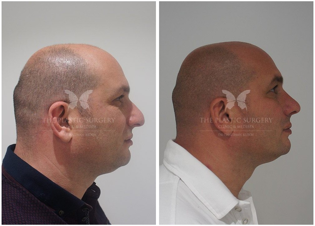 Rhinoplasty surgery, before and after 03, male patient, side view